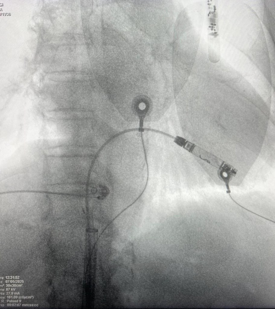 ospedale polistena pacemaker