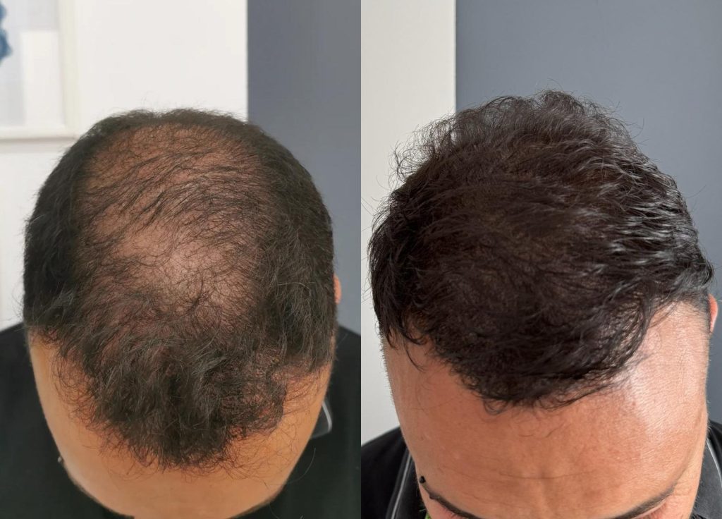 Anna Viola Tricopigmentazione