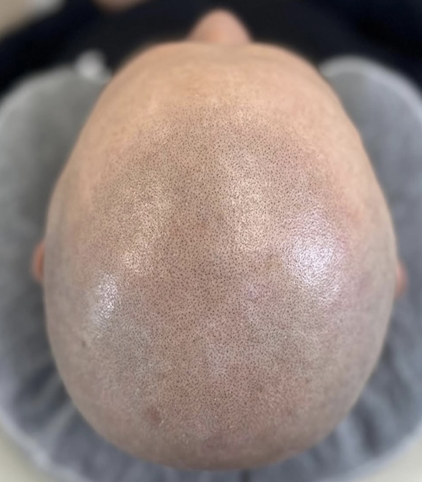 Anna Viola Tricopigmentazione