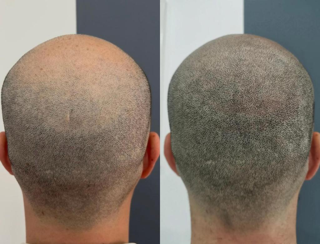 Anna Viola Tricopigmentazione