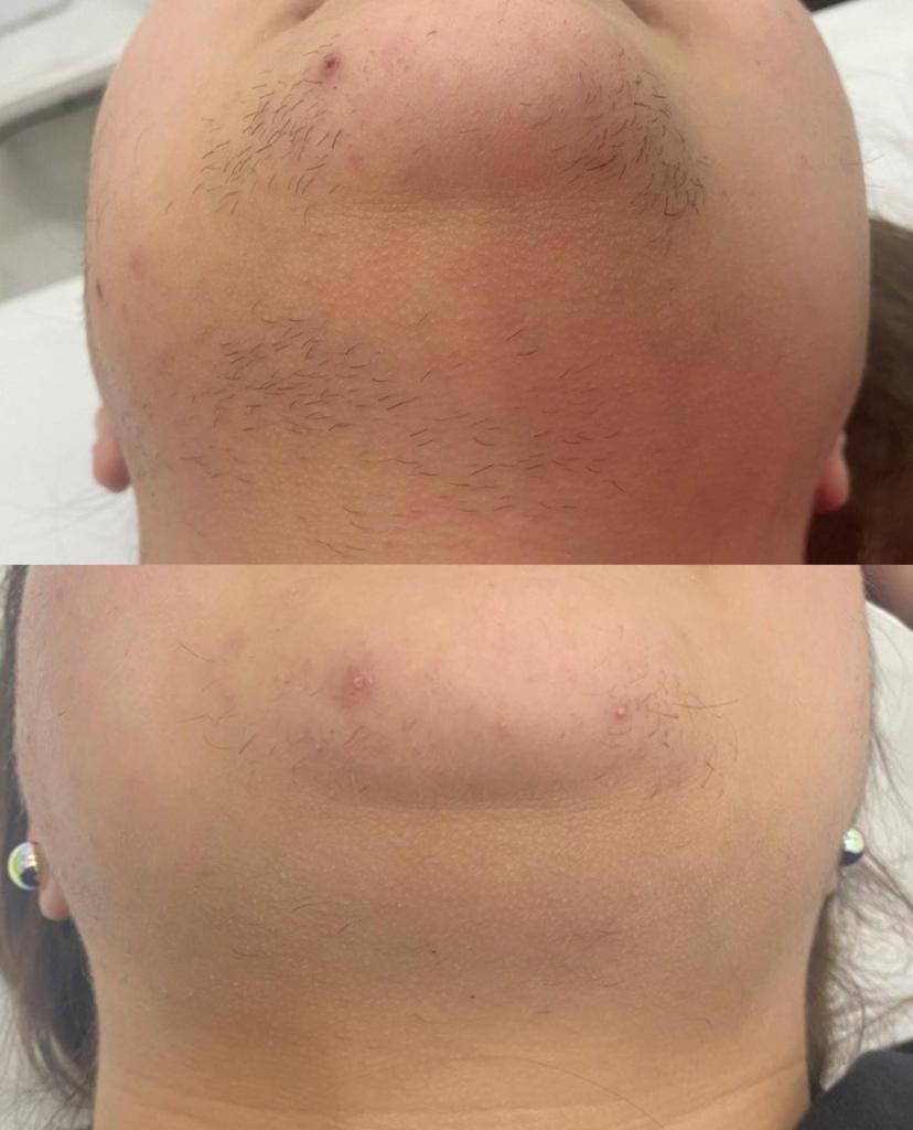 laser esthe dream rc