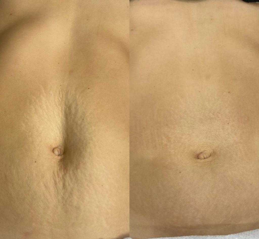 needling esthe dream