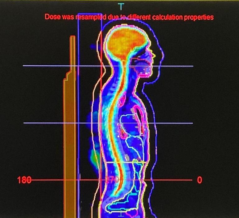 Total Body Irradiation ()
